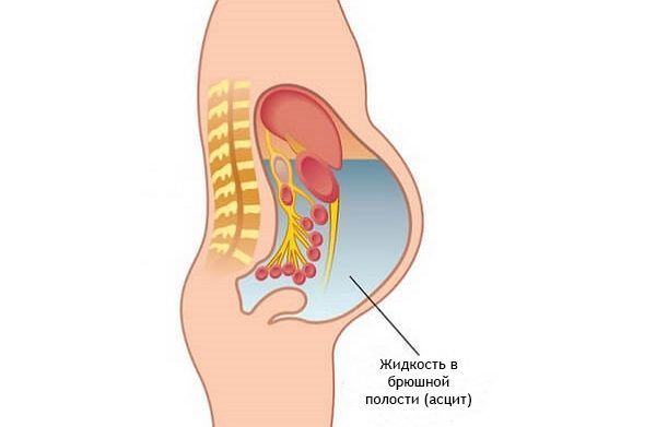 Асцит Асцит