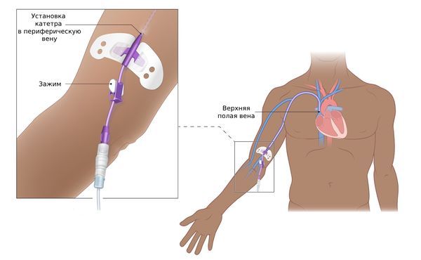 Катетеризация сердца Катетеризация сердца
