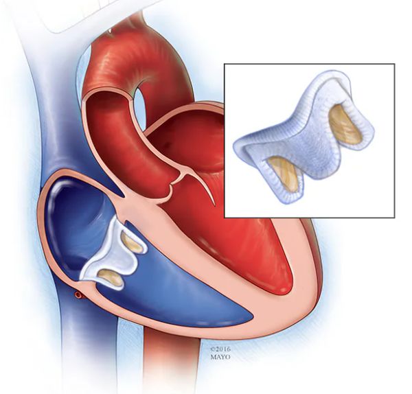 Замена трикуспидального клапана