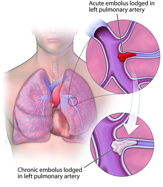 Хроническая тромбоэмболическая лёгочная гипертензия