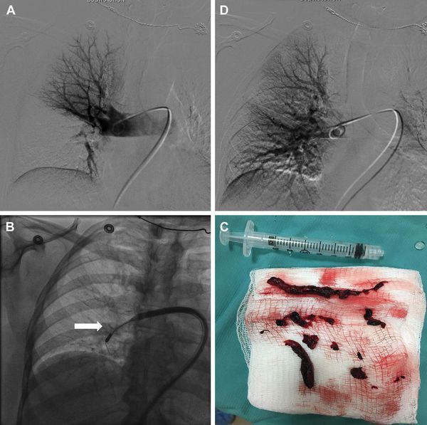 Этапы тромбэктомии [10]