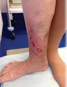 Трофическая язва [31]
