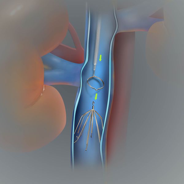 Имплантация кава-фильтра в нижнюю полую вену