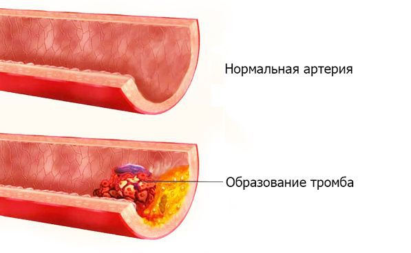 Тромбоз артерии