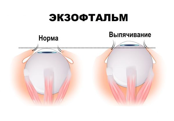 Экзофтальм