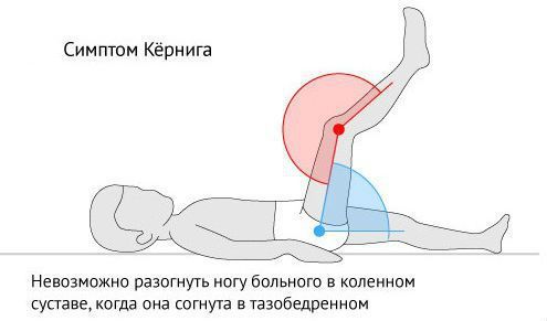 Симптом Кёрнига Симптом Кёрнига