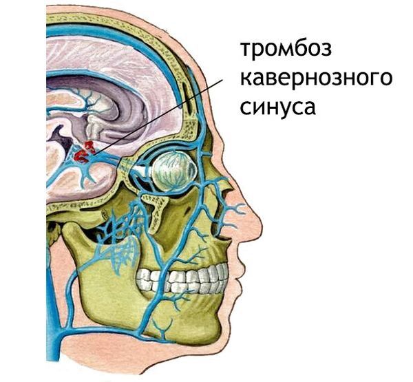 Тромбоз кавернозного синуса Тромбоз кавернозного синуса
