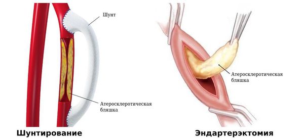 Тромбоз мезентериальных сосудов кишечника клиника