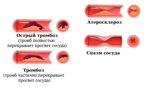 Сосуд при тромбозе, атеросклерозе и спазме