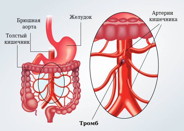 Тромбоз артерии кишечника