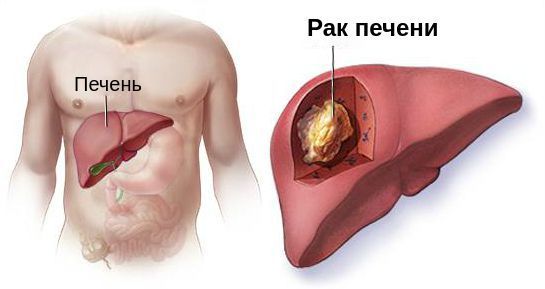 Гепатоцеллюлярная карцинома