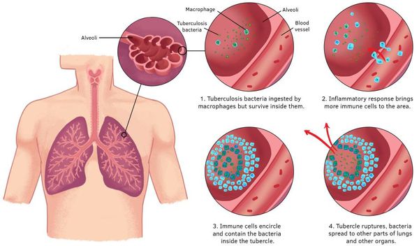 Развитие туберкулёза лёгких