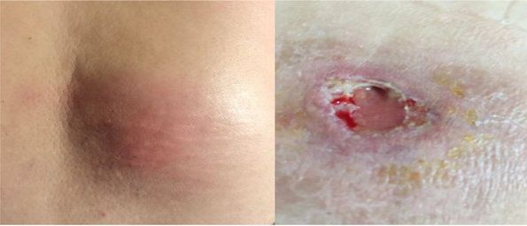 Абсцесс и свищ рядом с позвоночником [14]