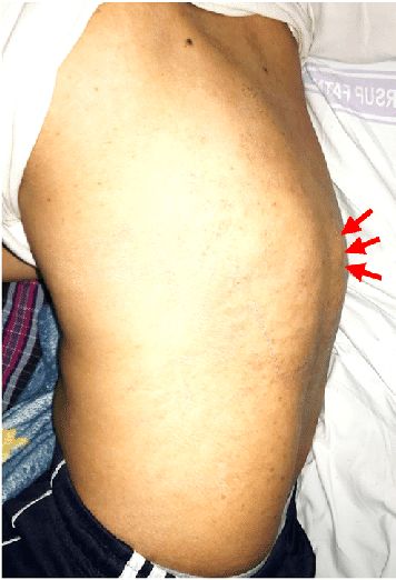 Кифотическая деформация (горб) при туберкулёзе позвоночника [15]