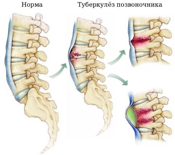 Поражение позвоночника при туберкулёзе [13]