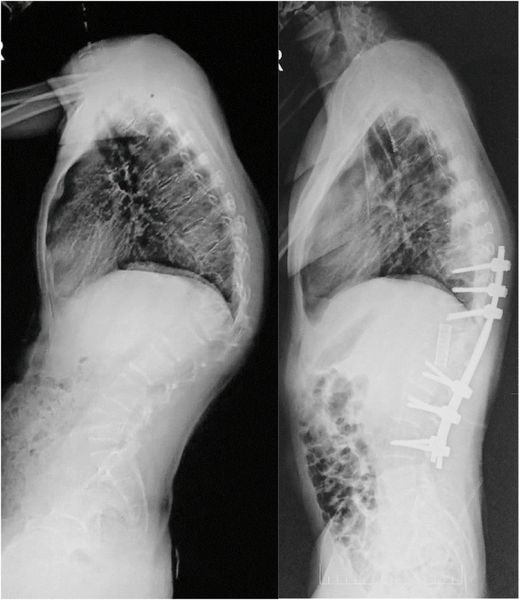 Транспедикулярная фиксация позвоночника [15]