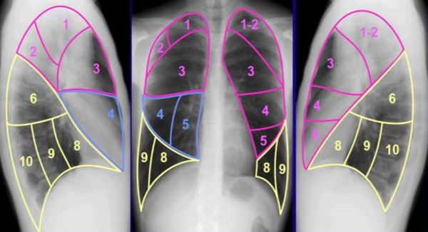 Сегменты лёгких
