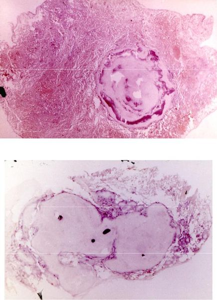 Слоистая и конгломератная туберкулёмы [11]
