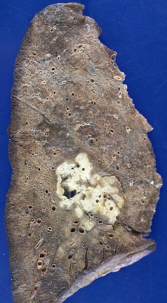 Туберкулёма [16]