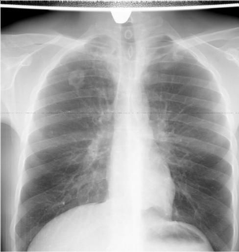 Туберкулёма в стадии распада [11]