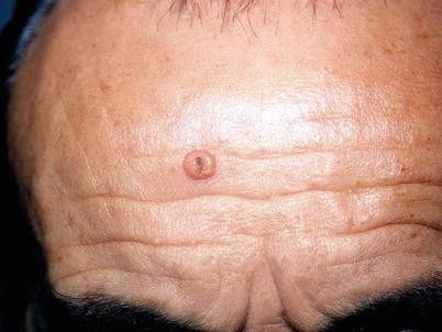 Аденома сальных желёз [31]