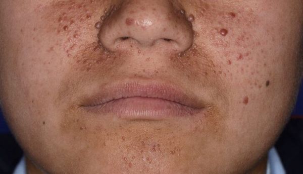 Ангиофибромы (кожные гамартомы) [28]