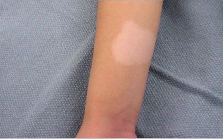 Гипопигментные пятна (лист ясеня) на руке [27]