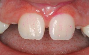 Ямки на эмали [32]