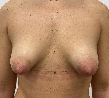 Двусторонняя тубулярная грудь [16] (нажмите на изображение, чтобы его увидеть)