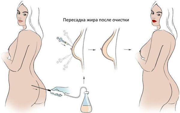 Липофилинг груди