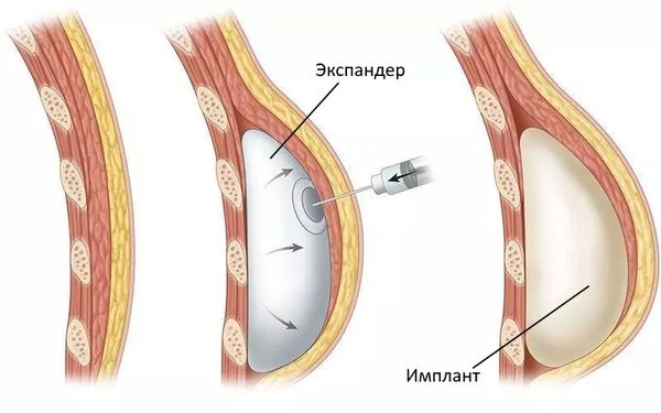 Тканевый экспандер