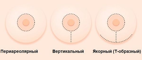 Виды подтяжки груди