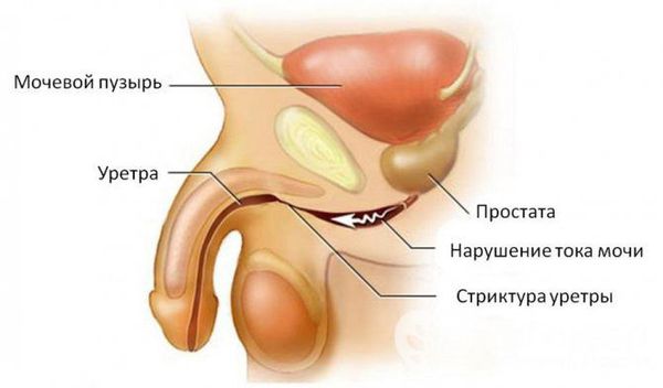 uretritis mint a prosztatitis oka)