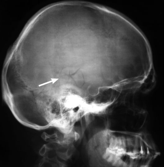 Перелом черепа на рентгенограмме