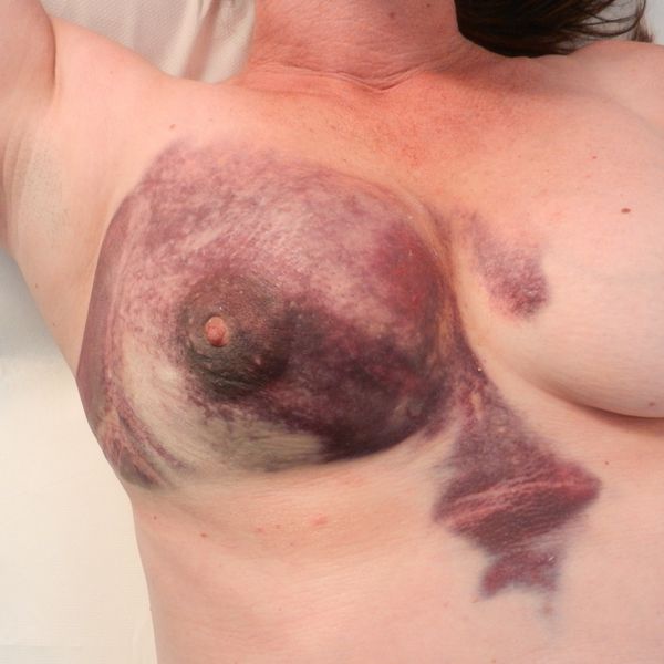 Ушиб груди с гематомой [31] (чтобы увидеть изображение, нажмите на него)