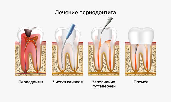 Эндодонтическое лечение периодонтита