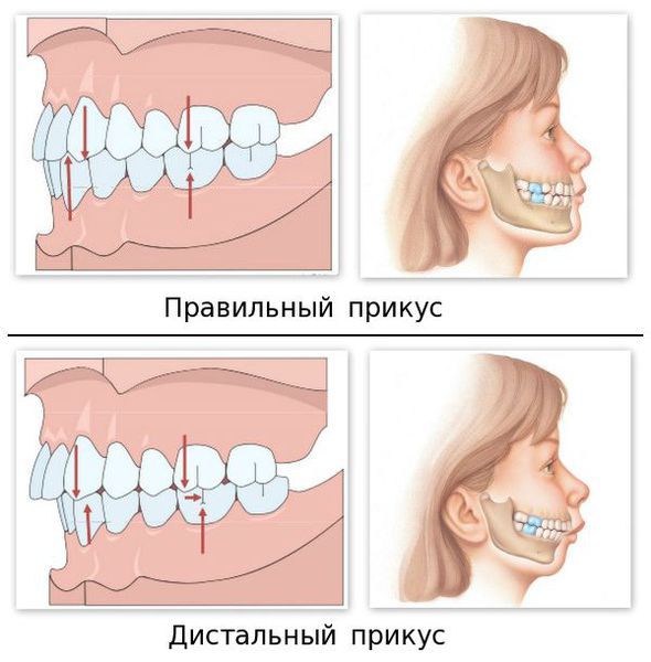 Правильный и дистальный прикус Правильный и дистальный прикус