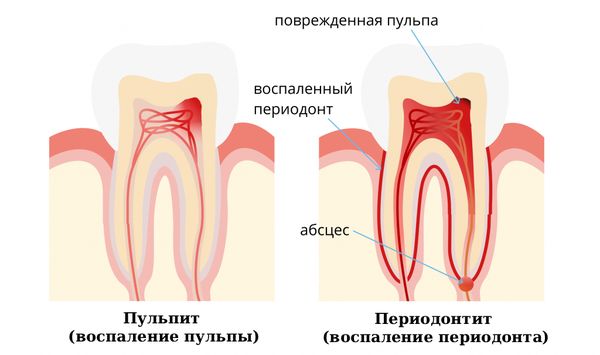 Пульпит, периодонтит и абсцесс Пульпит, периодонтит и абсцесс