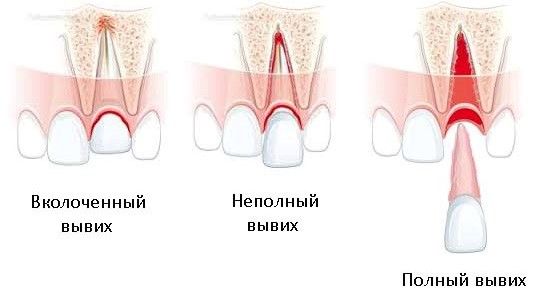 Вывих зуба Вывих зуба