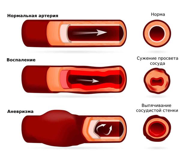 Воспаление и аневризма артерии