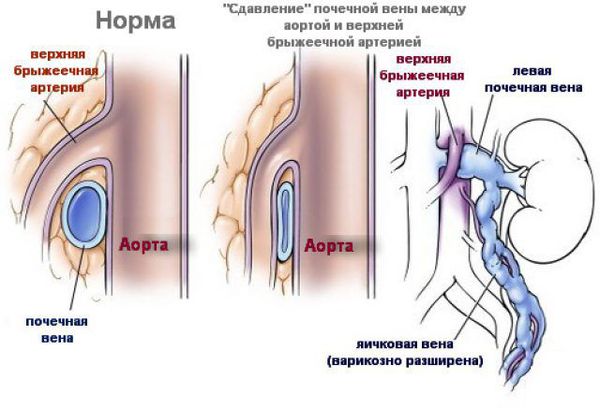 Лечение варикоцеле