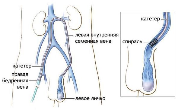 Операция по поводу гидроцеле (операция Винкельмана)