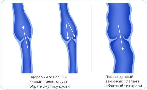 Варикоз на ногах - симптомы, диагностика, лечение