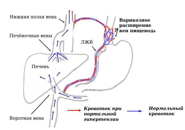 Аномальный кровоток по левой желудочной вене при портальной гипертензии