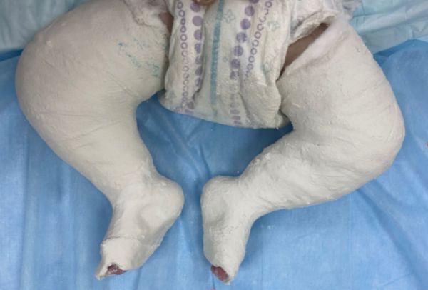 Гипсование ребёнка с вертикальным тараном [4]