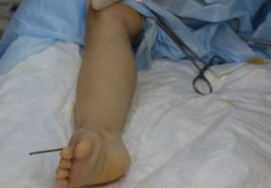 Малоинвазивная операция с фиксацией спицей Киршнера (отсутствие кровопотери и больших разрезов) [4]