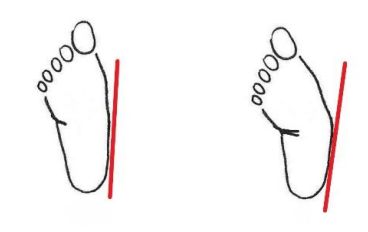 Отведение переднего отдела средней и тяжёлой степени [4]