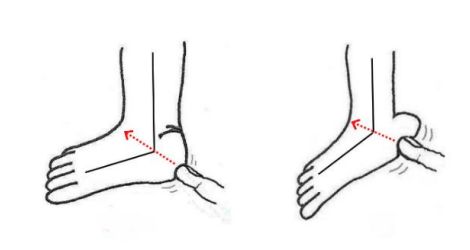 «Пустая пятка» средней и тяжёлой степени [4]