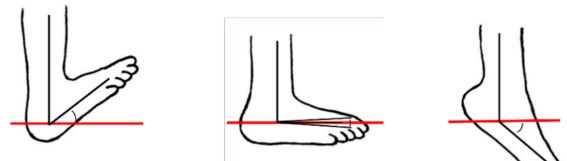Слева — нормальное сгибание. По центру и справа — ограничение тыльного сгибания средней и тяжёлой степени [4]