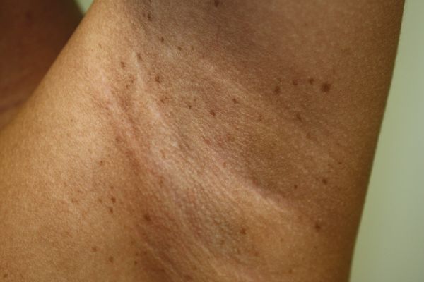 Симптом Кроува (аксиллярные веснушки) [22]